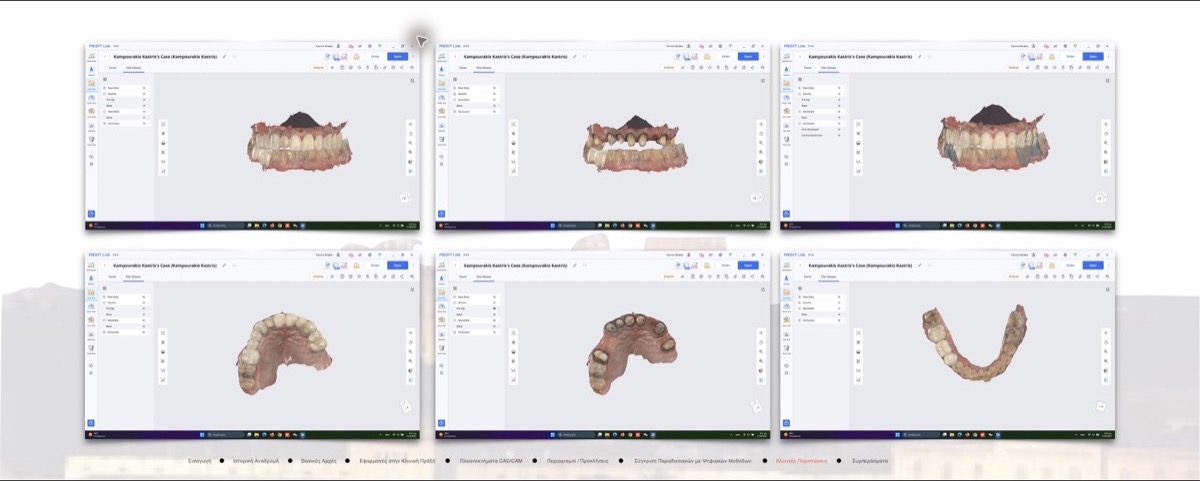 Digital intraoral record