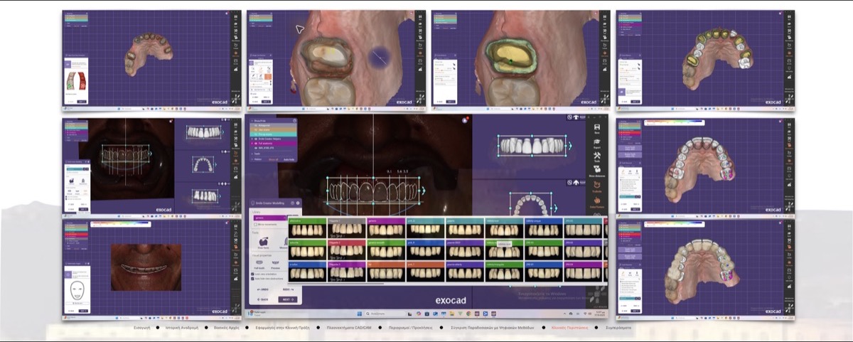 Digital restorative design
