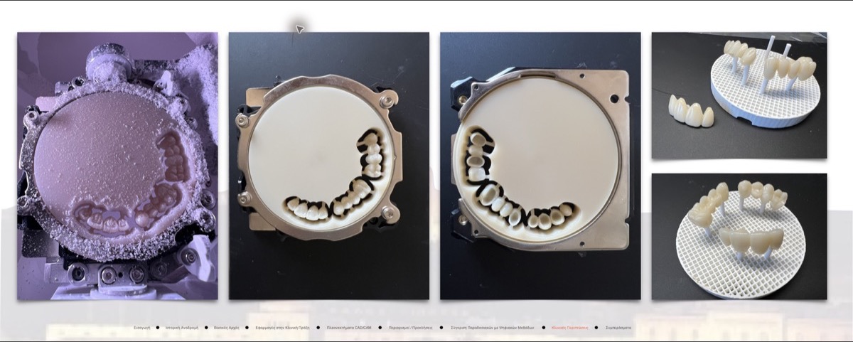PMMA provisional restoration