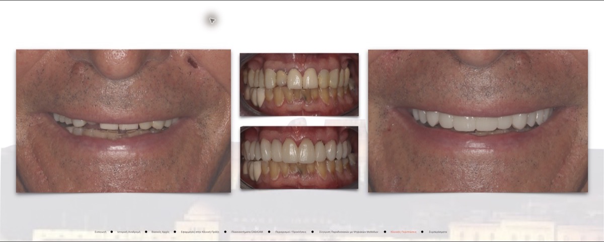 Final clinical result