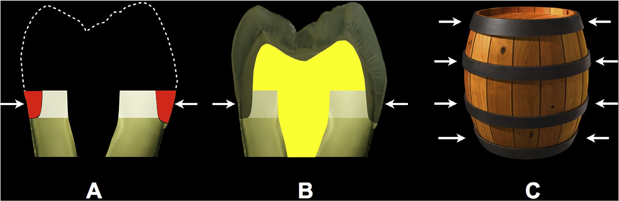 Illustration of the ferrule concept. Figure 1 from Stavridakis, Brokos and Krejci, 2018.